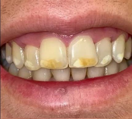 Tratamiento de ortodoncia 1 - Before