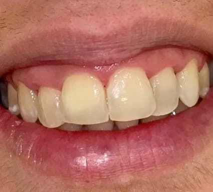 Tratamiento de ortodoncia 1 - After