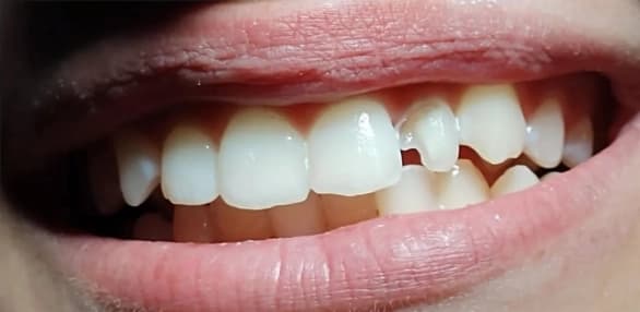 Tratamiento de ortodoncia 2 - Before