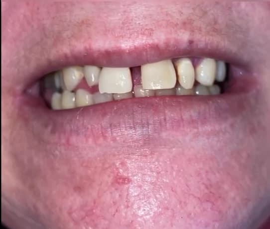 Tratamiento de ortodoncia 3 - Before