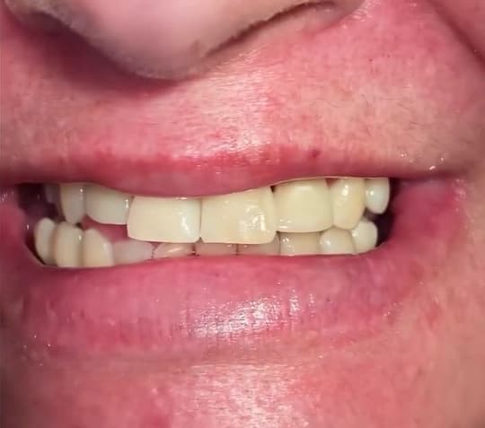 Tratamiento de ortodoncia 3 - After