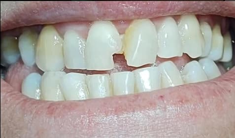 Tratamiento de ortodoncia 4 - Before